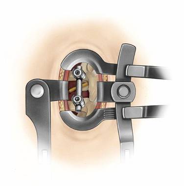 Product Picture Enlargement CW-Spine Classics MLD System