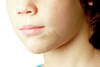 Scar Repair application child chin-Scar Repair application