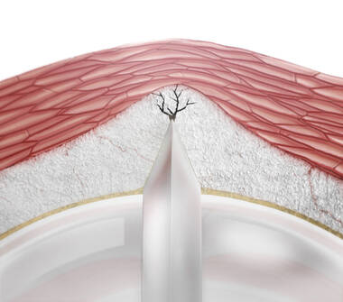 PTA High Pressure Scoring Balloon Catheter-NSE PTA Aperta