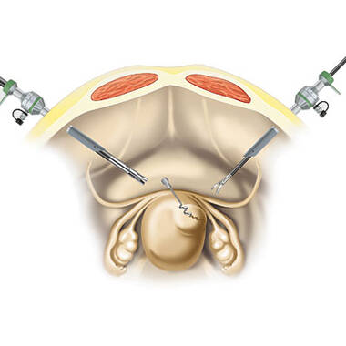 Product Picture Enlargement CW-Endoscopic Myoma Screw with Detachable Myoma Drill